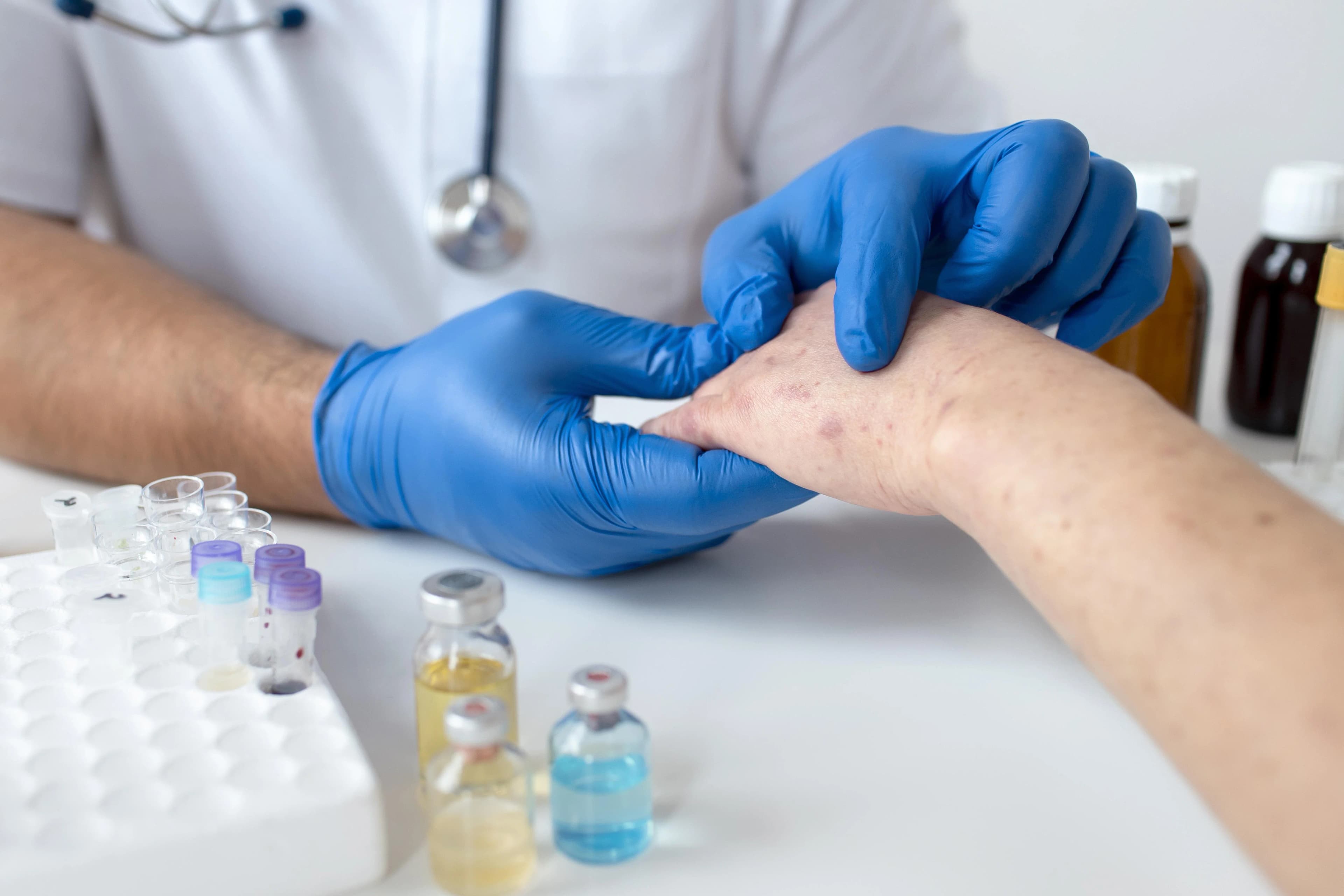 Eczema