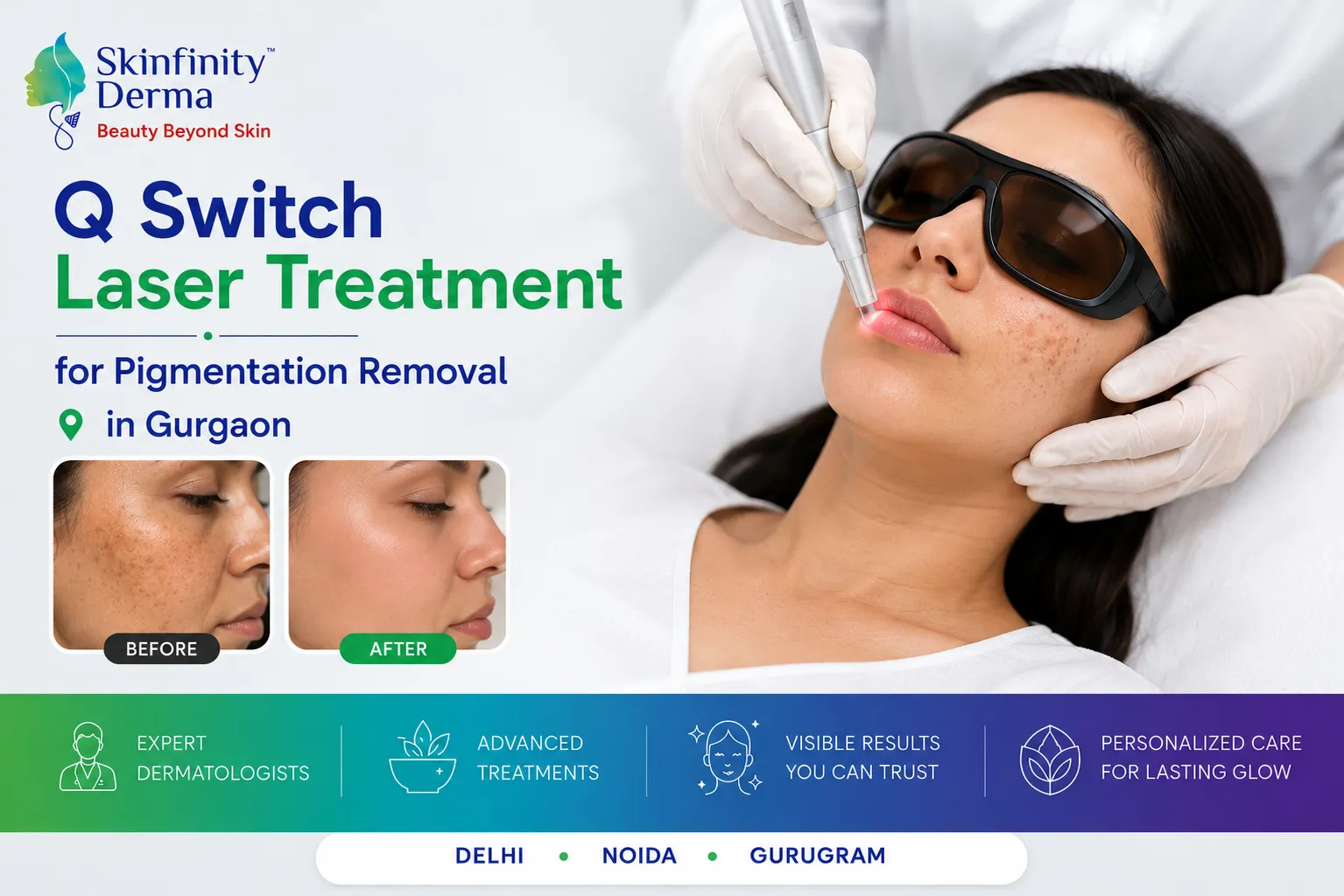 Q Switch Laser Treatment in Gurgaon, Q Switch Laser in Gurgaon