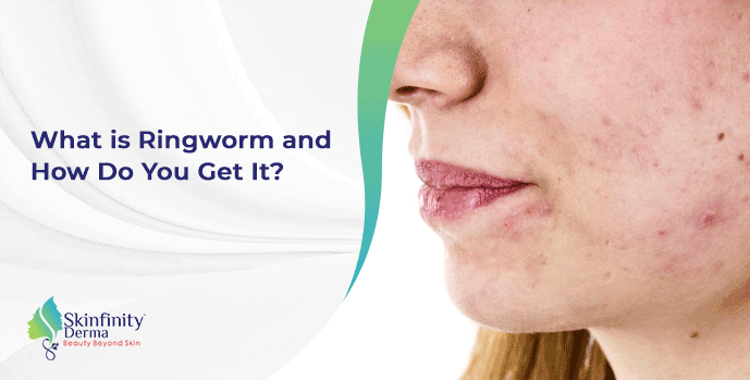 What Is Ringworm