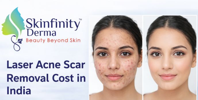 Laser Acne Scar Removal Cost in India