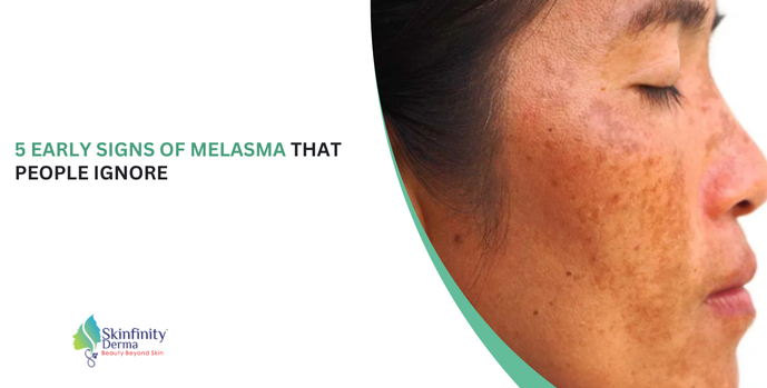 Signs of Melasma