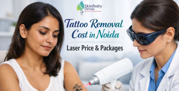 Tattoo removal cost in Noida