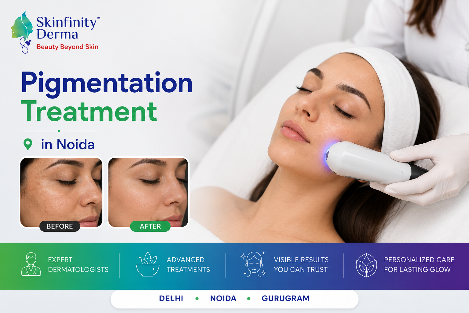 Pigmentation Treatment in Noida