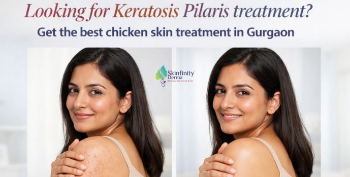 keratosis pilaris treatment in Gurgaon