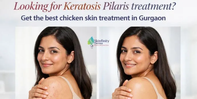 keratosis pilaris treatment in Gurgaon