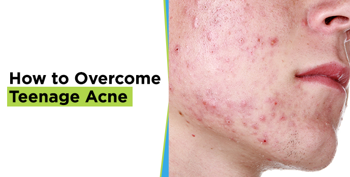 Teenage Acne 