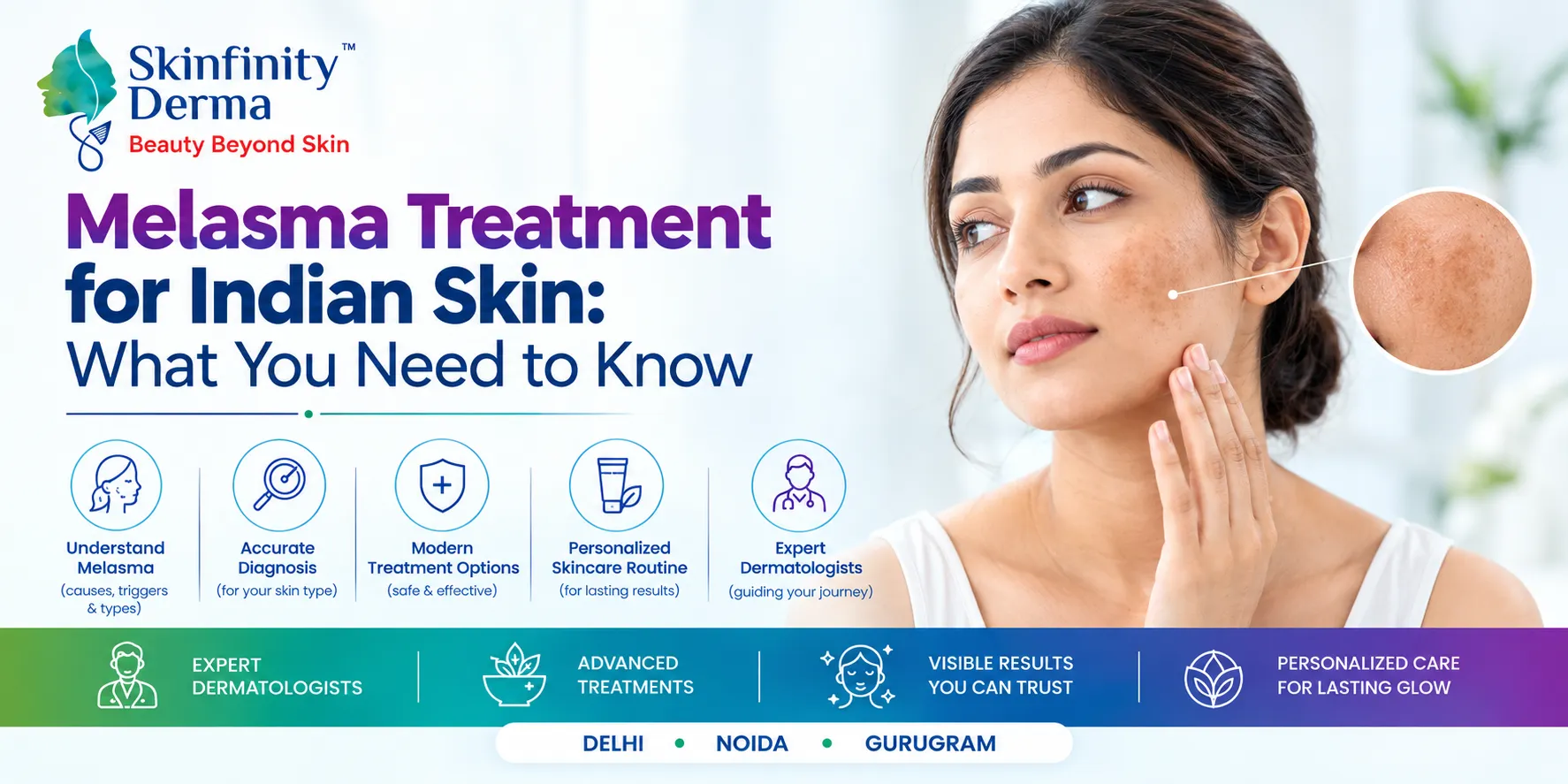 Melasma Treatment for Indian Skin