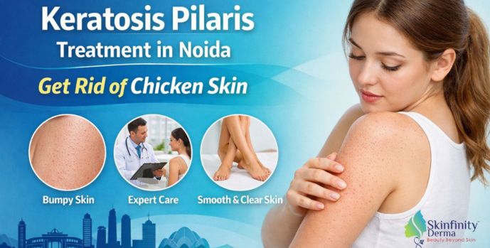 Keratosis Pilaris Treatment in Noida