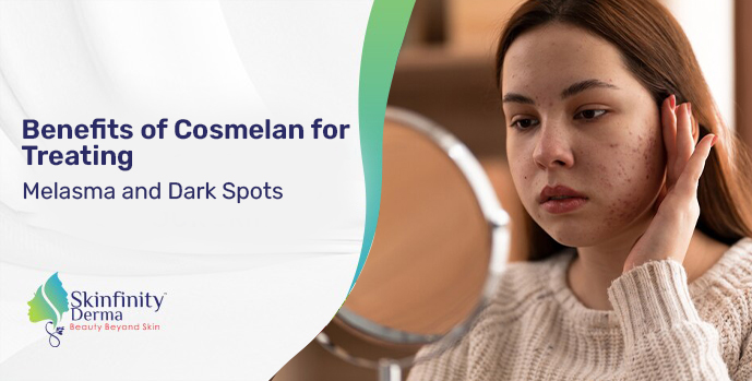 Cosmelan for Treating Melasma and Dark Spots