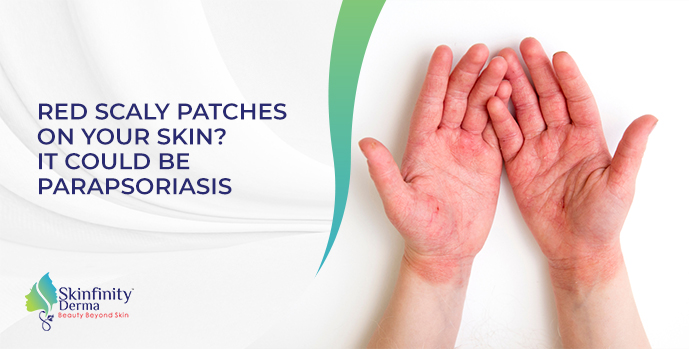 RED SCALY PATCHES ON YOUR SKIN