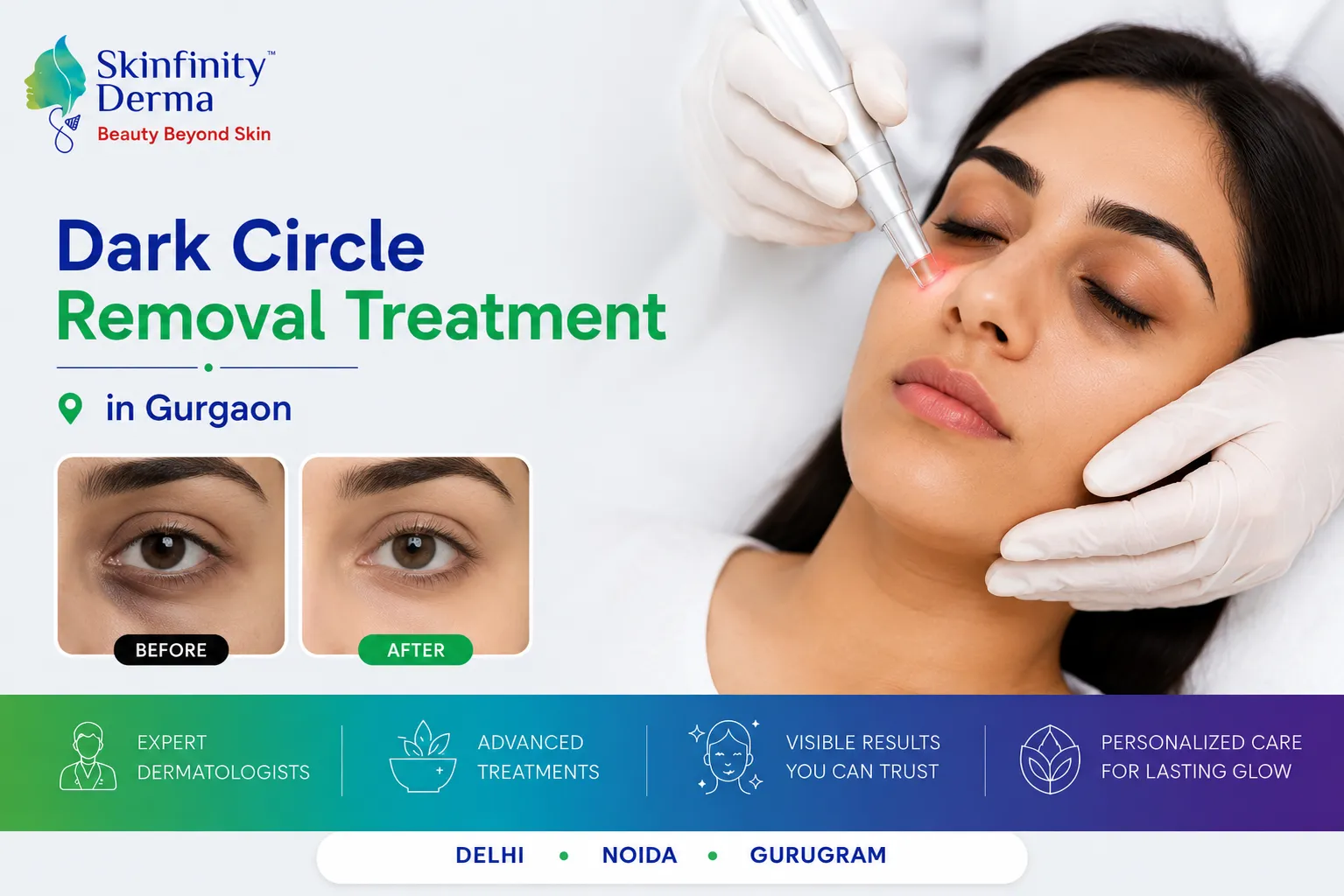 Dark Circles Treatment in Gurgaon