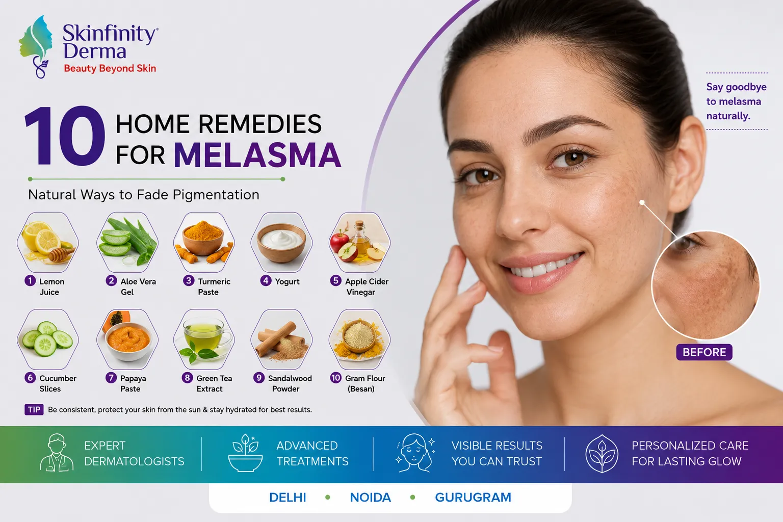 Home Remedies for Melasma