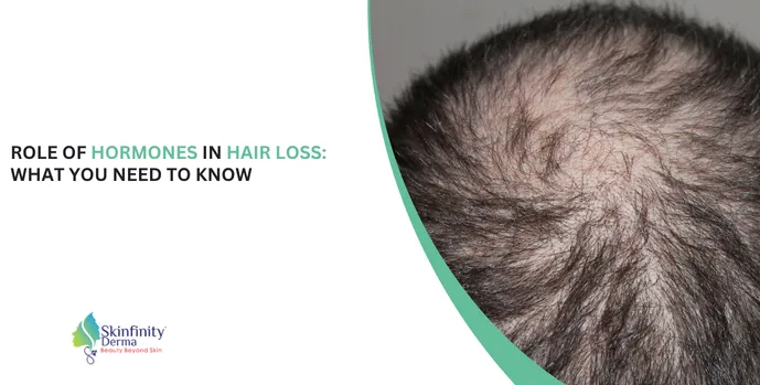 Hormonal hair loss