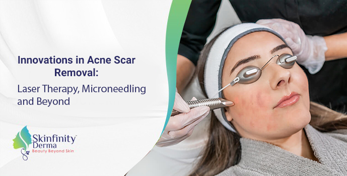 Acne Scar Removal