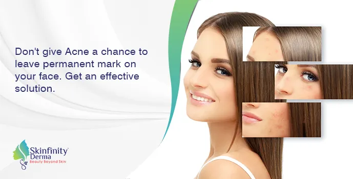 acne scar treatment in Noida