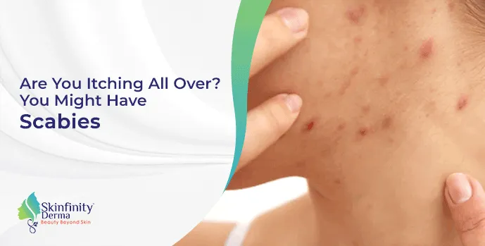 Are You Itching All Over? You Might Have Scabies