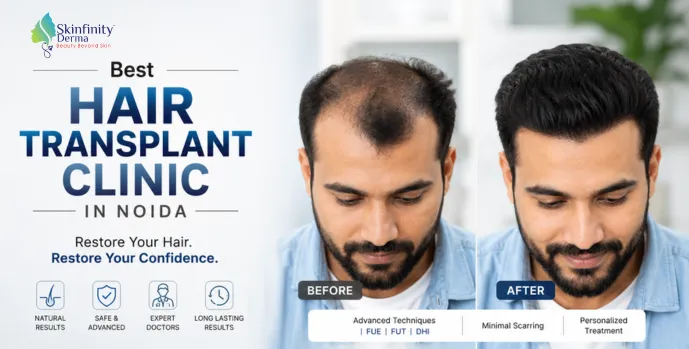 Best Hair Transpant Clinic in Noida