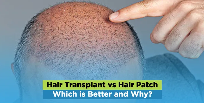 Hair Transplant vs. Hair Patch