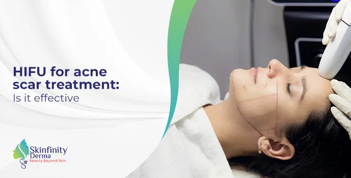 HIFU for acne scar treatment