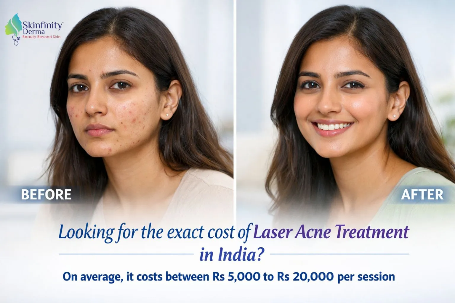 Laser Acne Scar Removal Cost in India