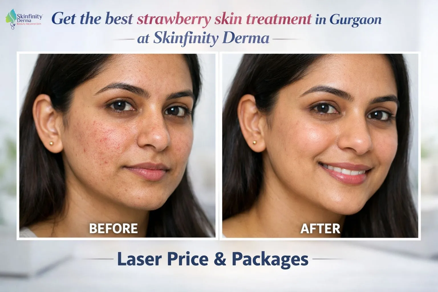 Strawberry skin treatment before after Skinfinity Derma