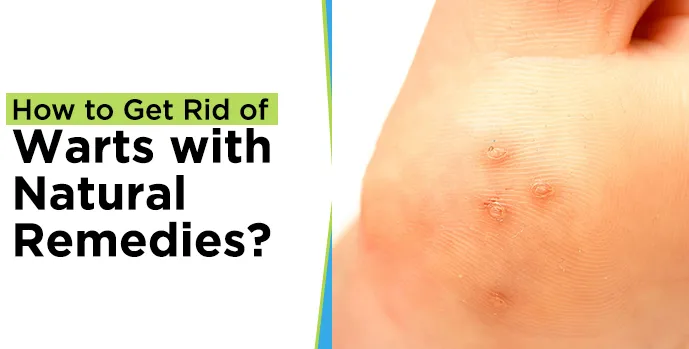 How to Get Rid of Warts with Natural Remedies?