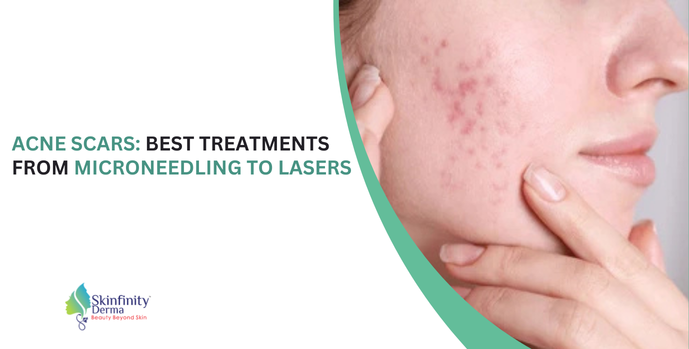 Acne Scars