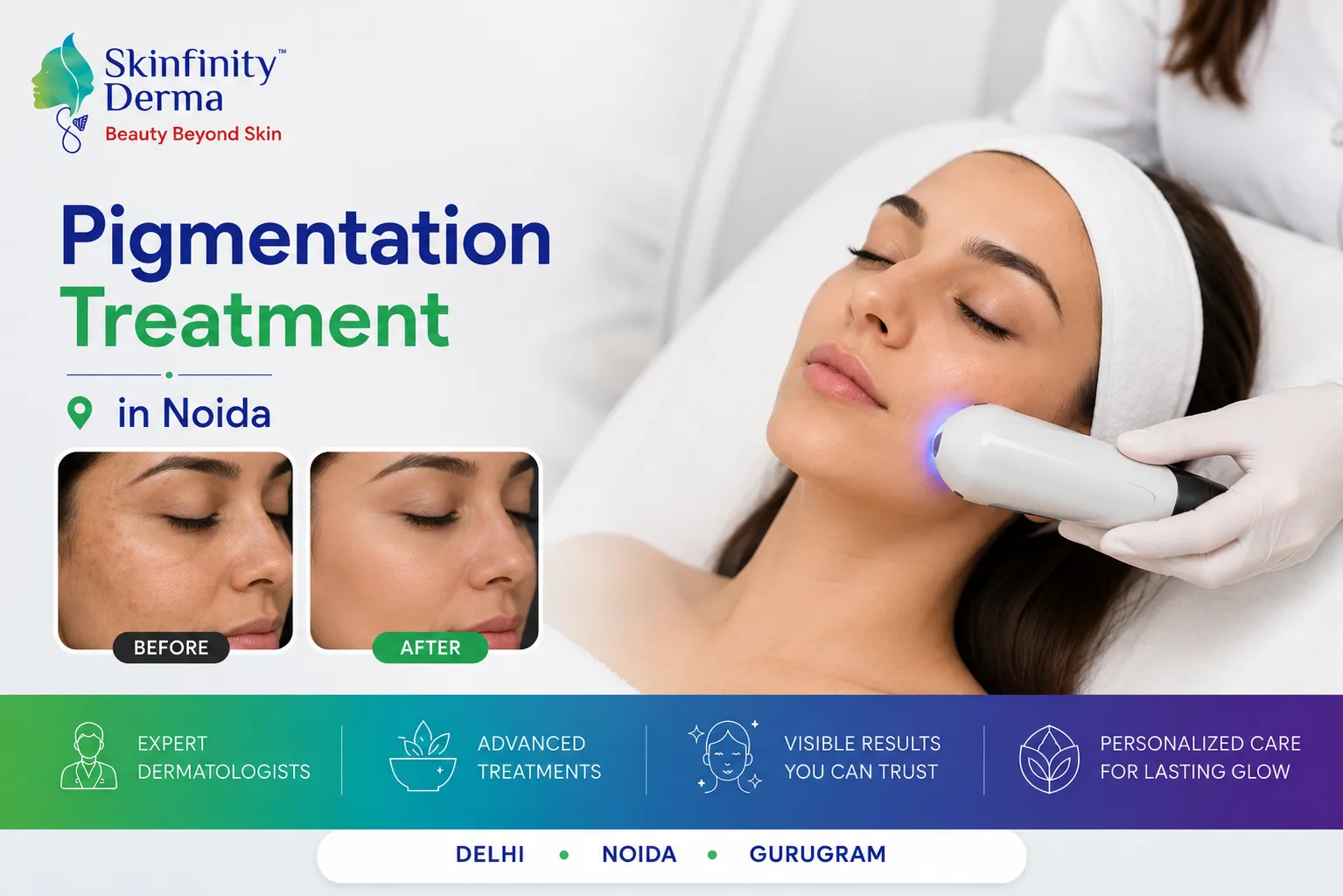 Pigmentation Treatment in Noida