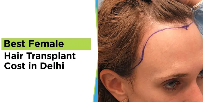  Female Hair Transplant Cost 
