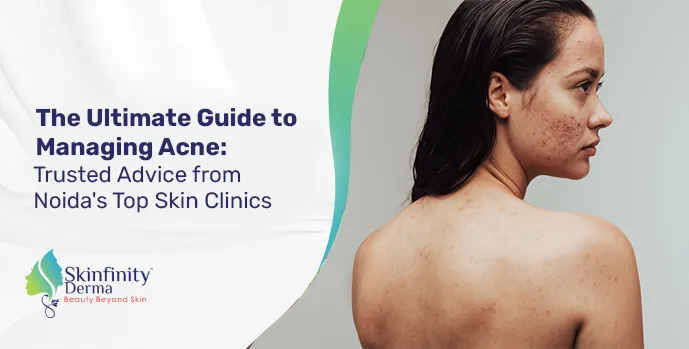 The Ultimate Guide to Managing Acne: Trusted Advice from Noida's Top Skin Clinics