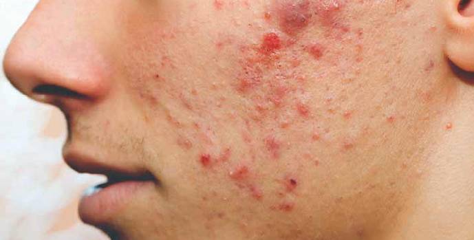 Acne : Pimple made Simple