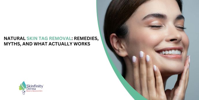Natural Skin Tag Removal