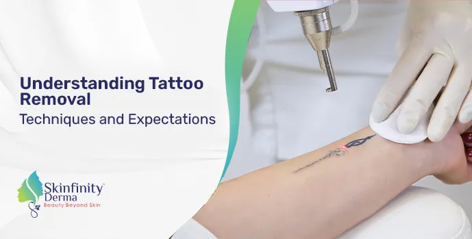 Tattoo Removal