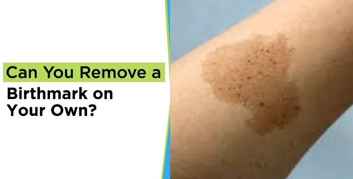 Remove a Birthmark 