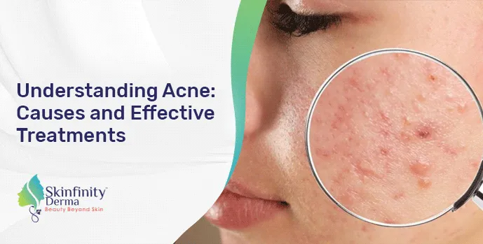 Acne Treatment