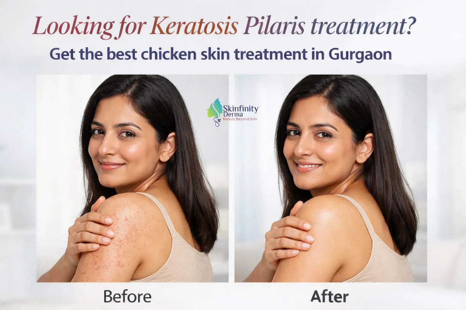 keratosis pilaris treatment in Gurgaon