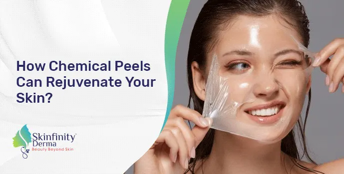 Chemical Peel Treatment