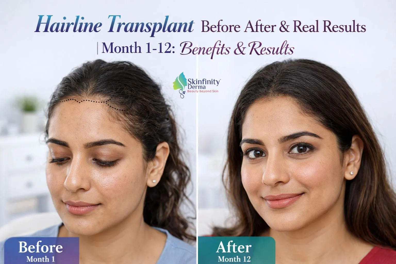 Hairline Transplant Before After & Real Results