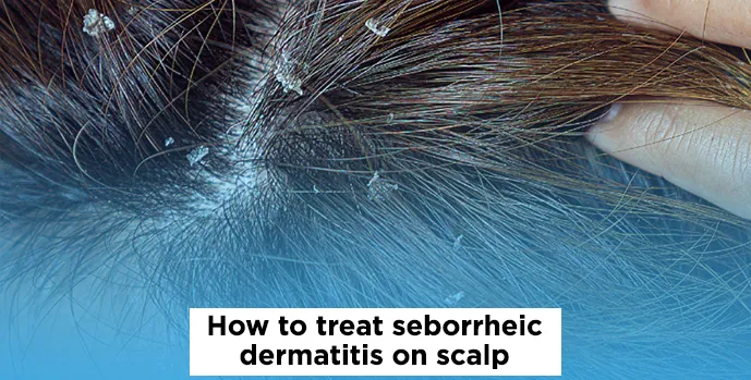 Seborrheic Dermatitis 