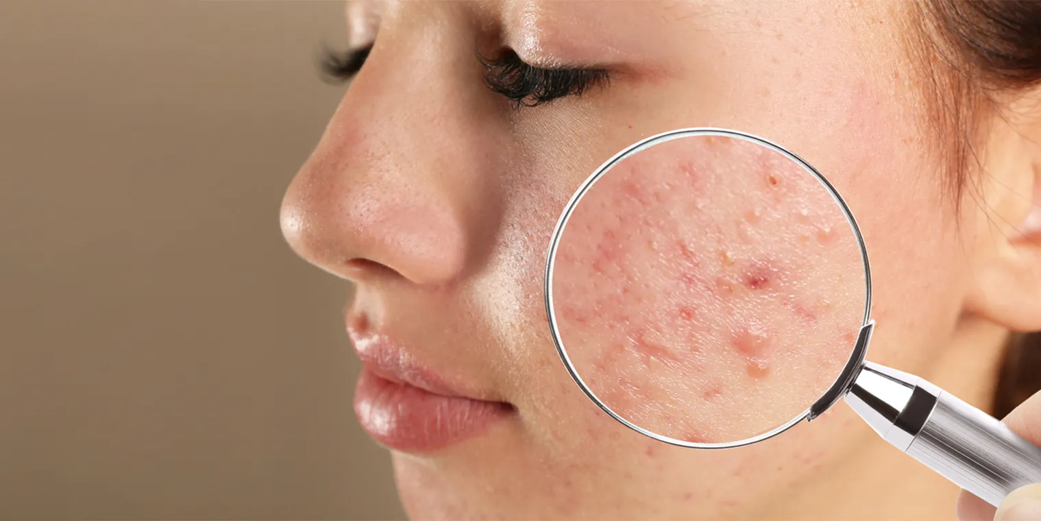 Best Acne & Scars Treatment in Noida: The Complete Guide to Acne Scar Removal