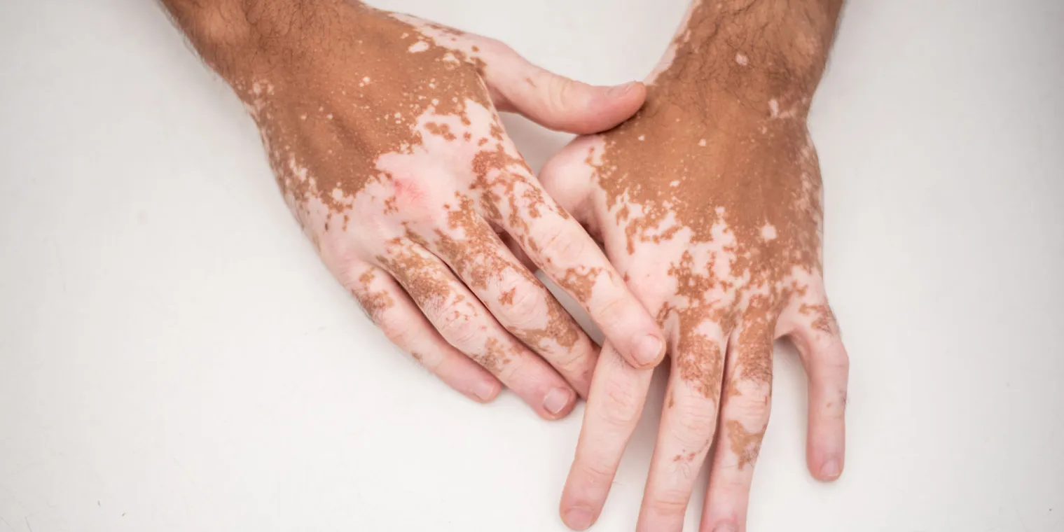 Vitiligo Gurgaon