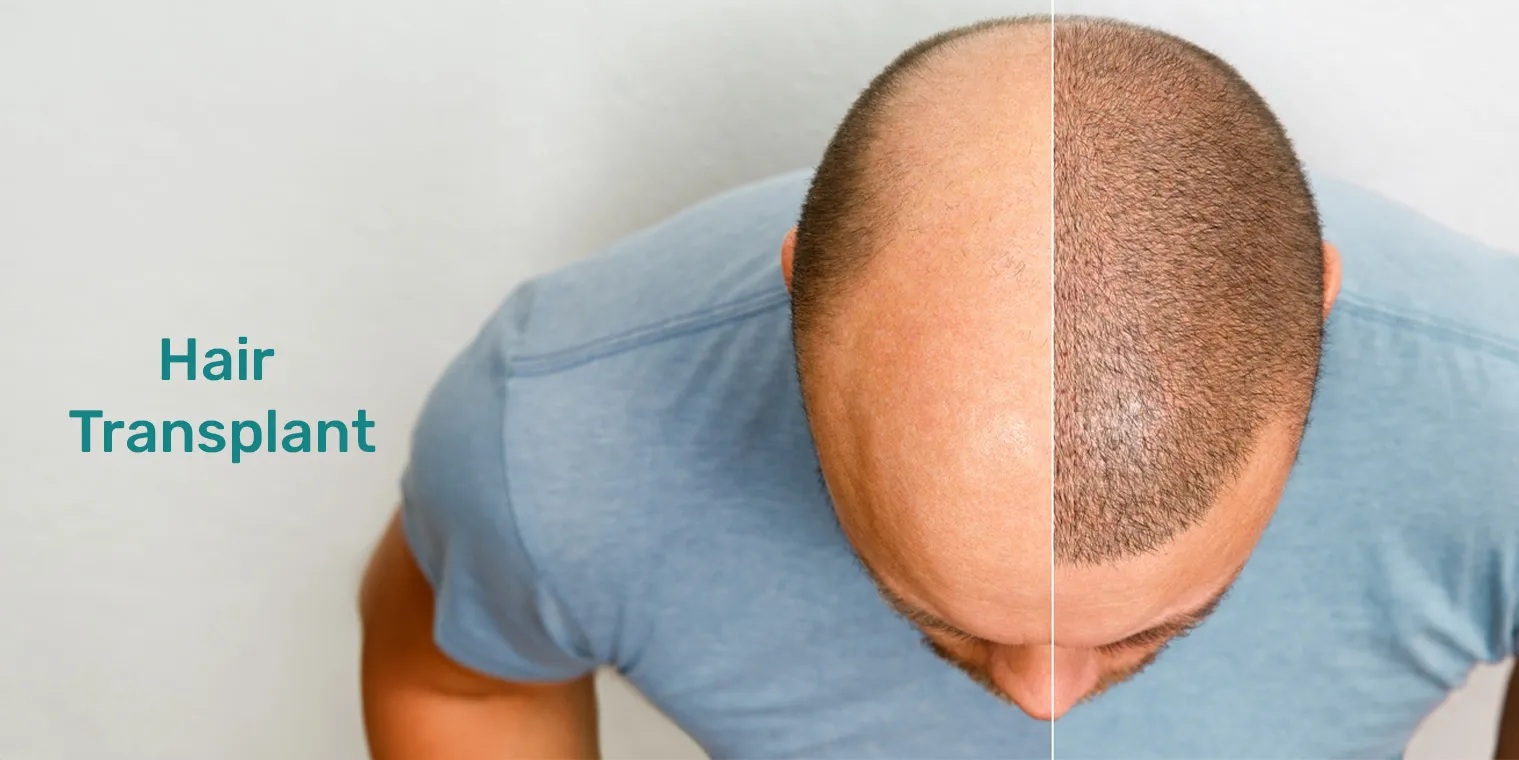 Hair Transplant