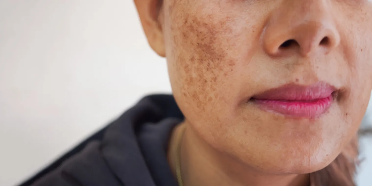 Melasma treatment
