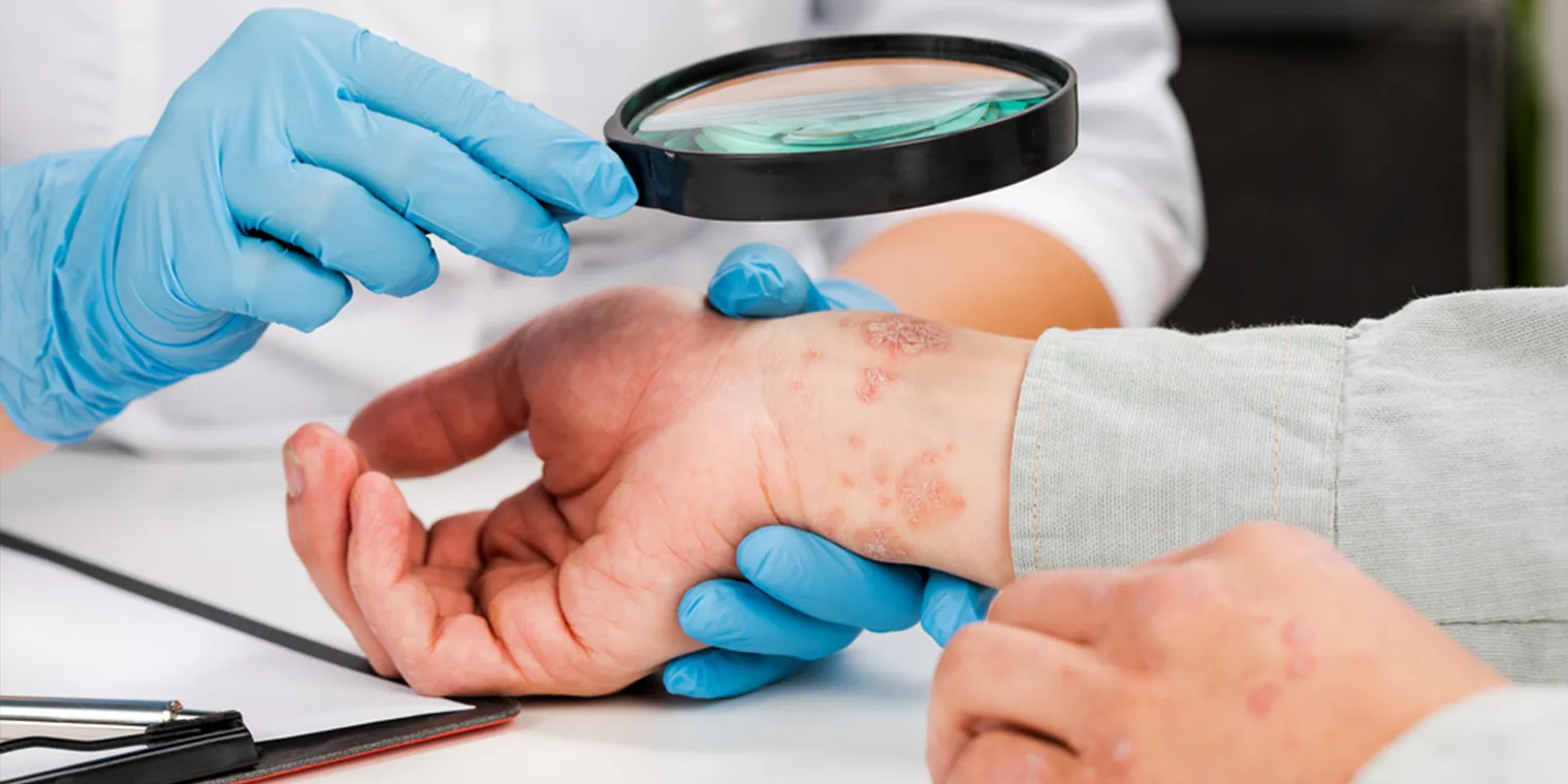 Psoriasis