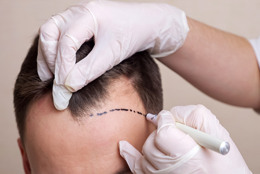 What is the average cost of hair transplant in Delhi NCR