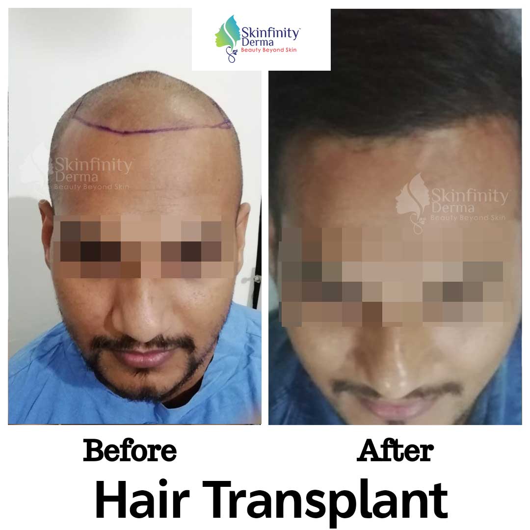 Best Hair Transplant Clinic in Noida | Hair Transplant in Noida -  Skinfinity Derma