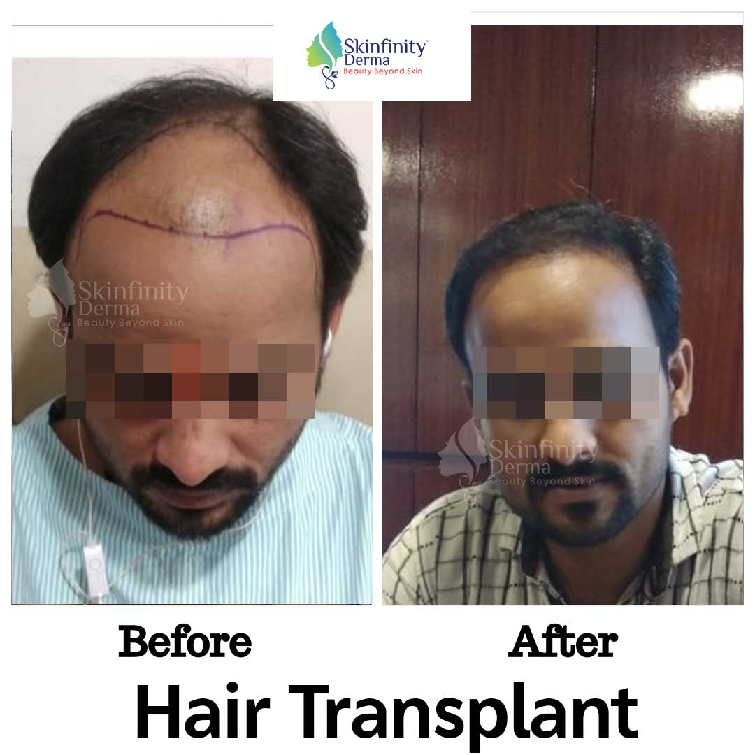Best Hair Transplant Clinic in Noida | Hair Transplant in Noida -  Skinfinity Derma