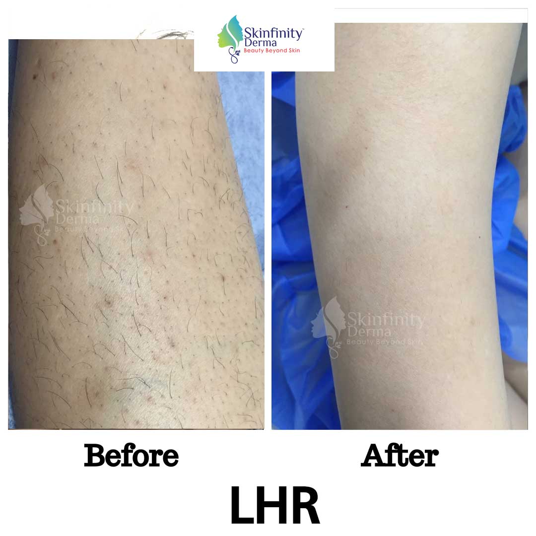 Laser Hair Removal Treatment in Faridabad  Skinette