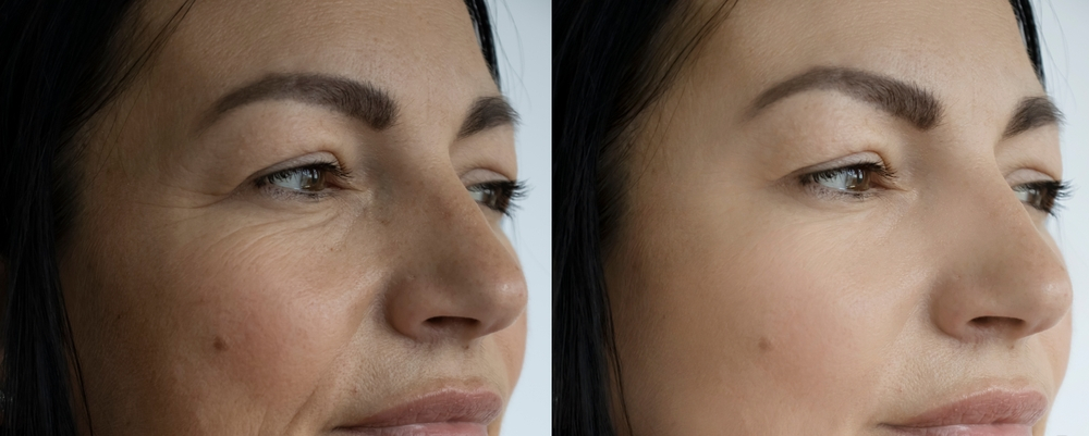 Viscoderm