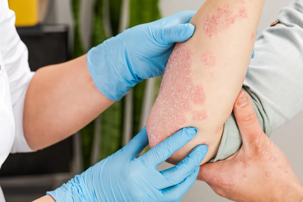 Psoriasis Treatment